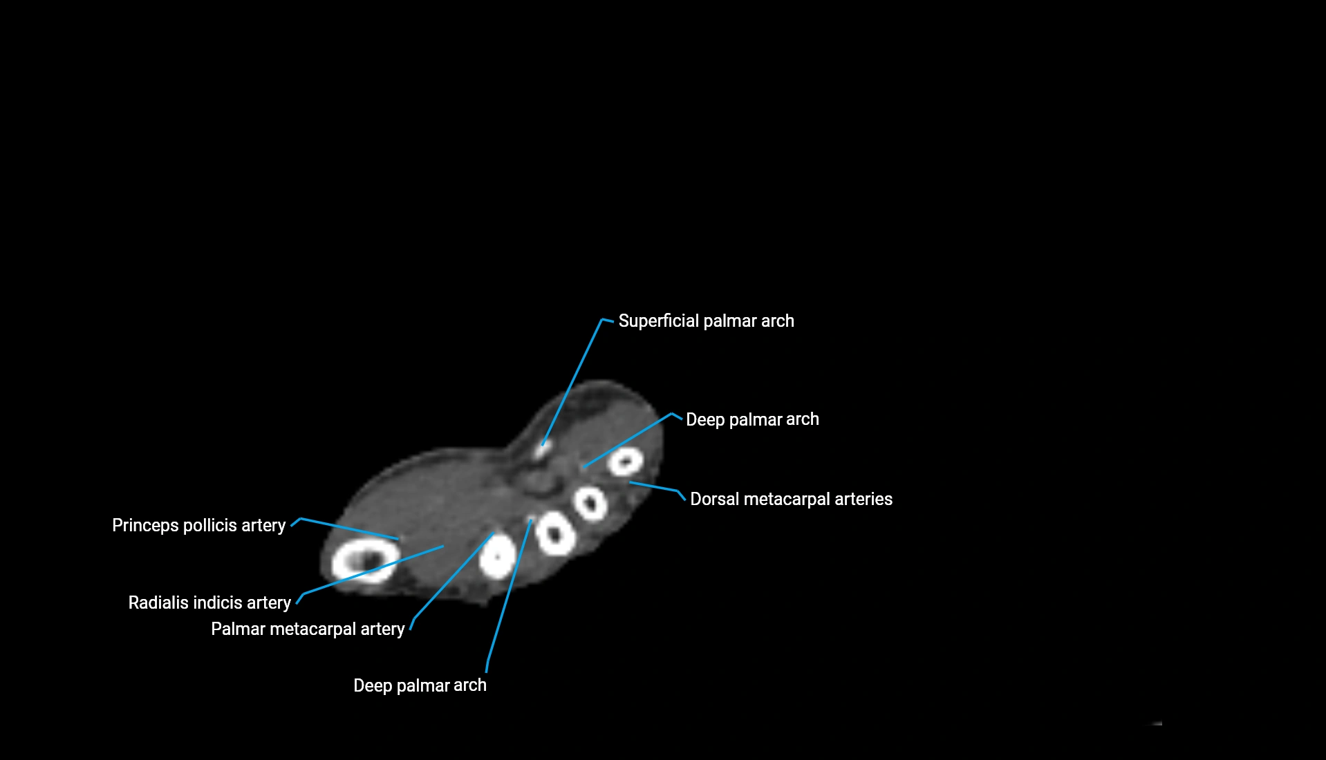 CTA upper limb axial cross sectional anatomy labelled image 63 (2).webp